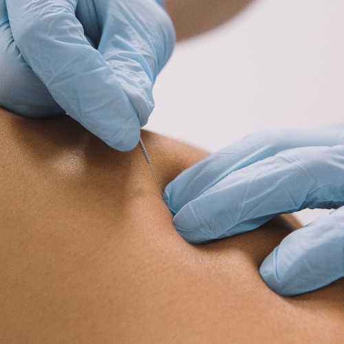 dry-needling-move-to-move-calgary-ab